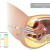 illustration artificial insemination. Intrauterine insemination IUI. Sperm injected into uterus
