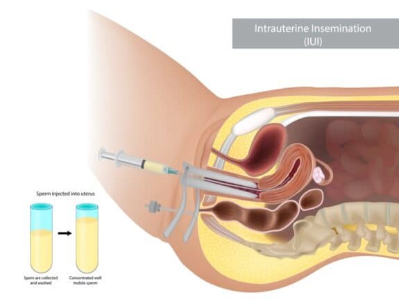 illustration artificial insemination. Intrauterine insemination IUI. Sperm injected into uterus