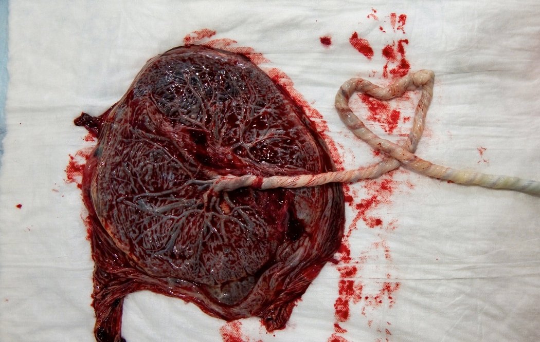 human placenta in the hospital
