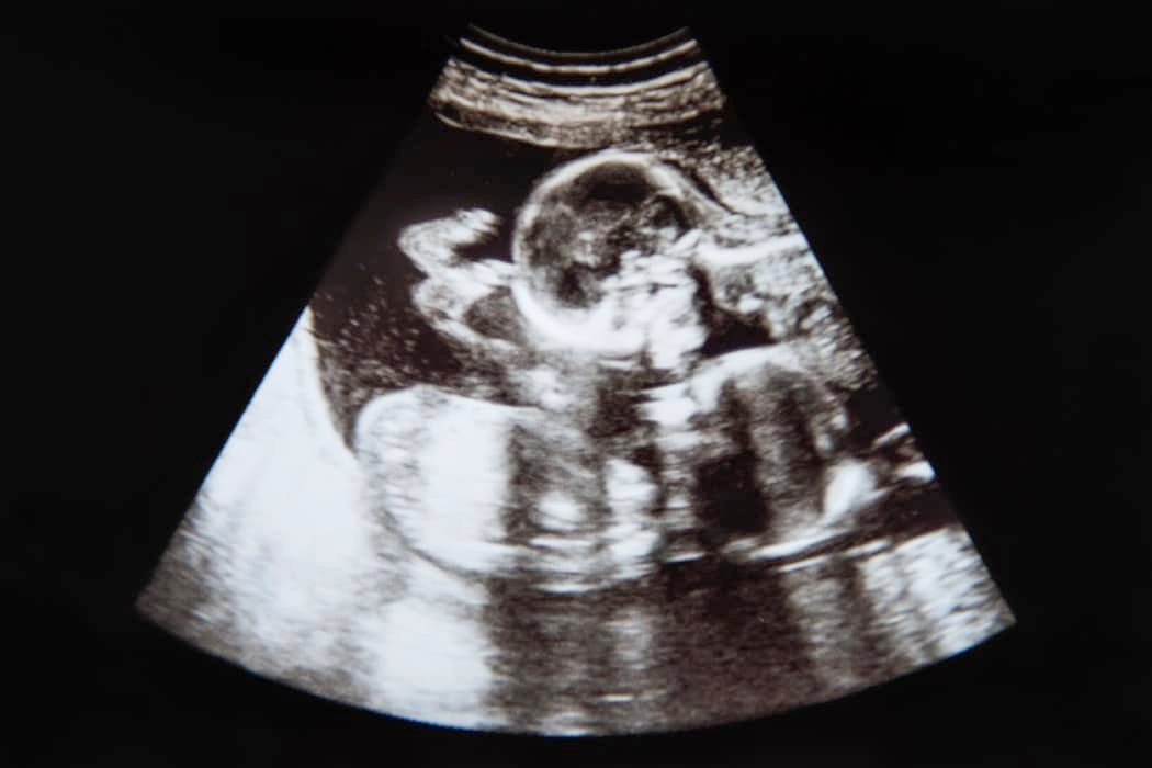 twin pregnancy ultrasound